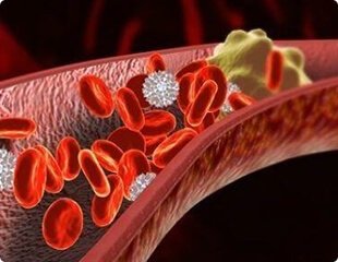 Bekuan darah menyekat arteri - punca serangan jantung
